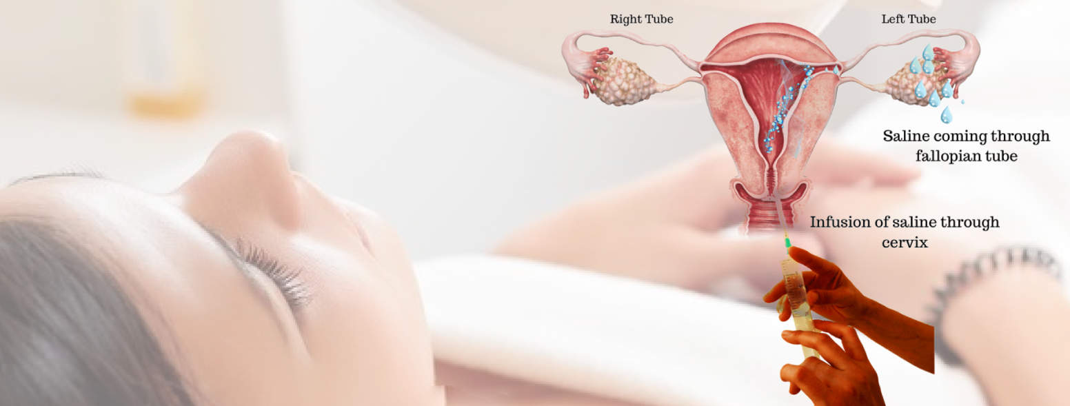 Saline Infusion Sonohysterography Process for Infertility Treatment
