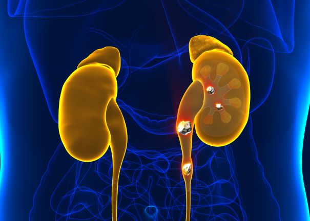 Kidney Stone Inset and Treatment