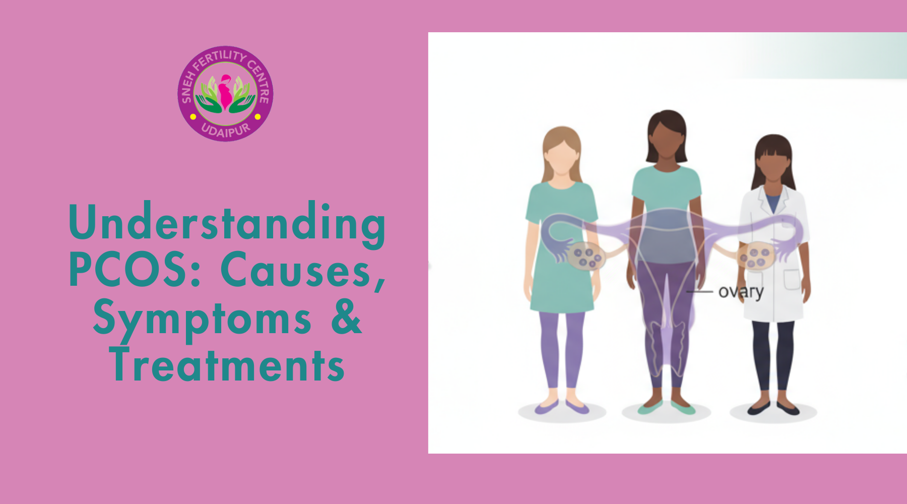 PCOS causes symptoms and treatments